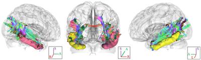 Enhanced white matter fiber tract of the cortical visual system in visual artists: implications for creativity